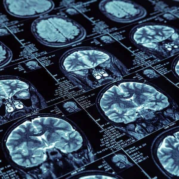 Brain MRI scans showing detailed images of brain structures and tissues.