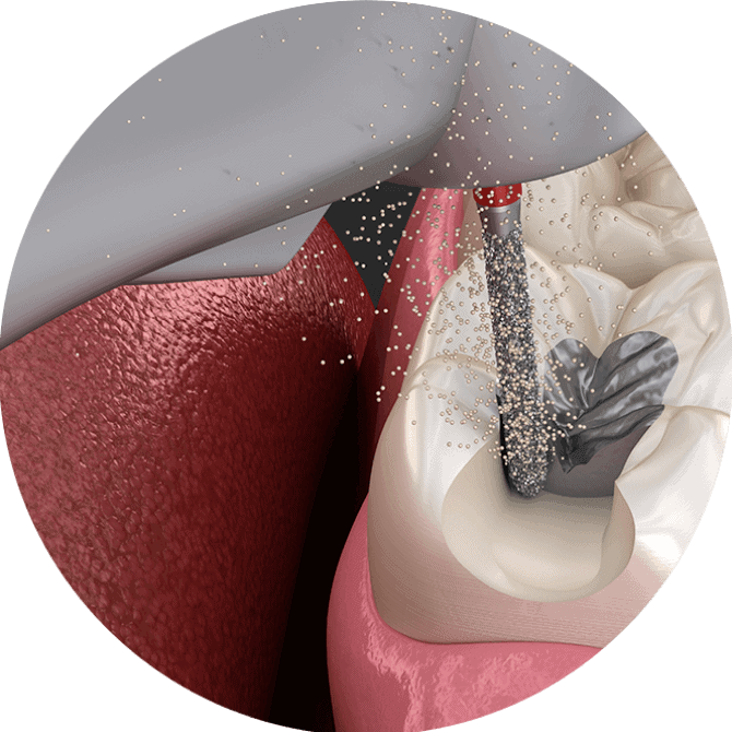 amalgam 1