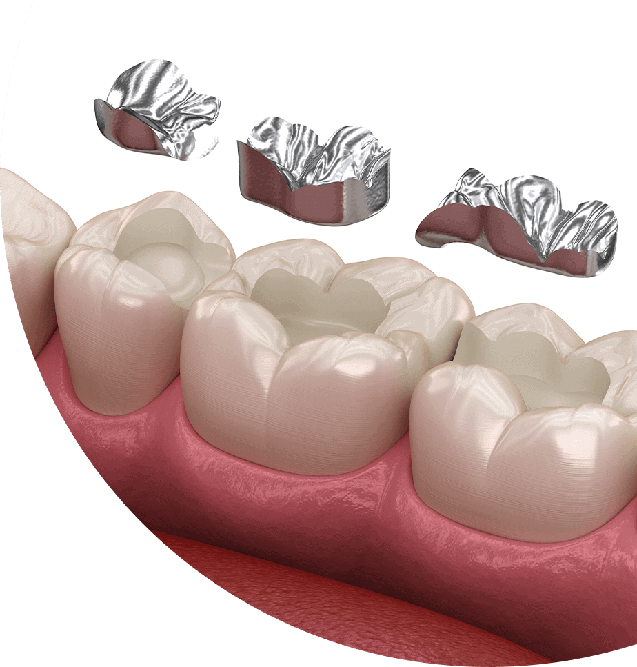 amalgam