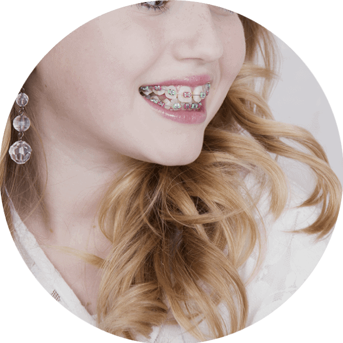 braces 1