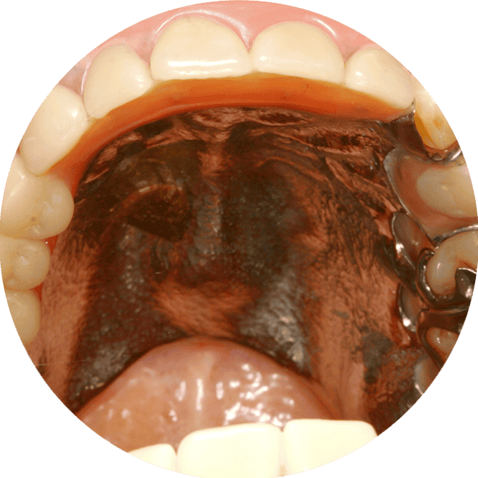 denture