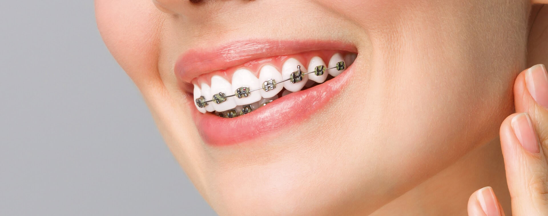 Fixed braces in Solihull at Ascent Dental Solihull