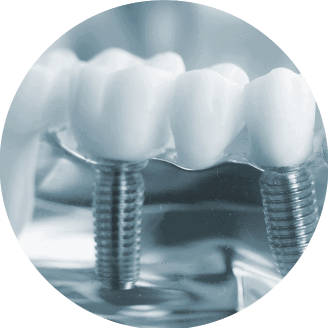implant2
