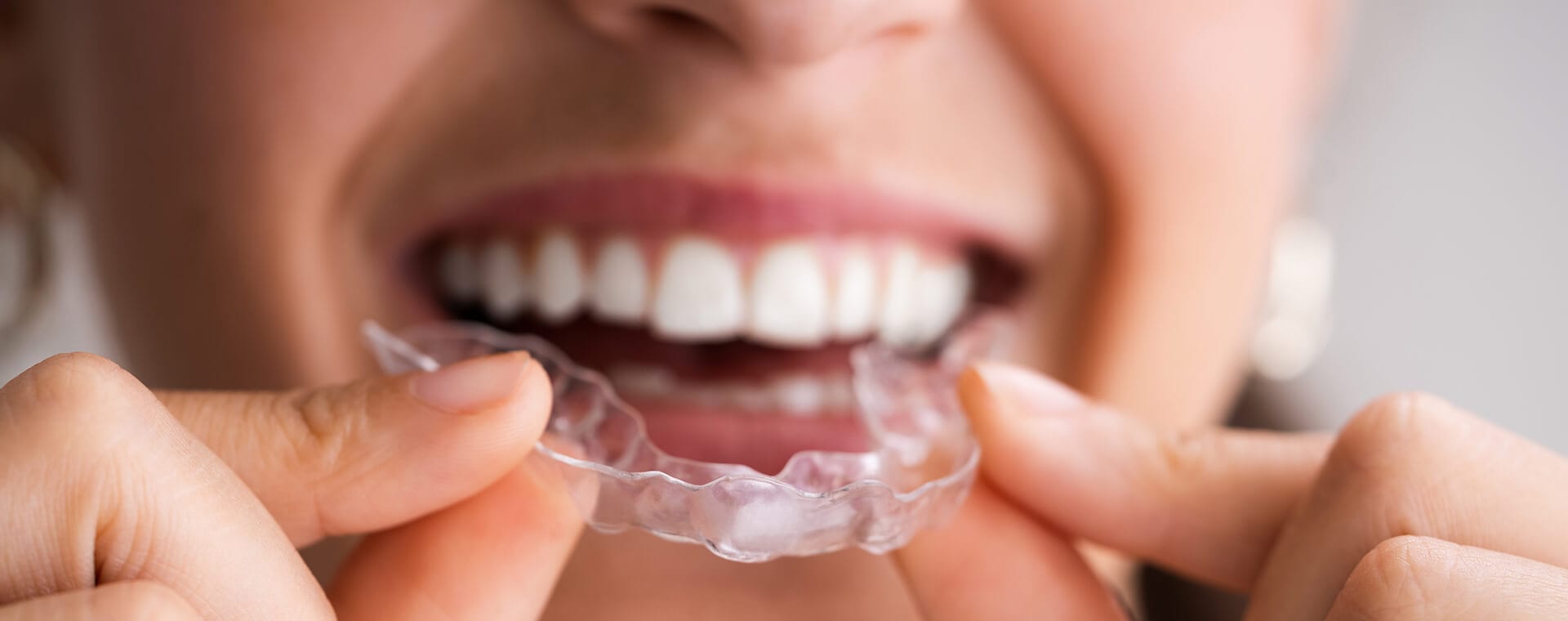 retainers