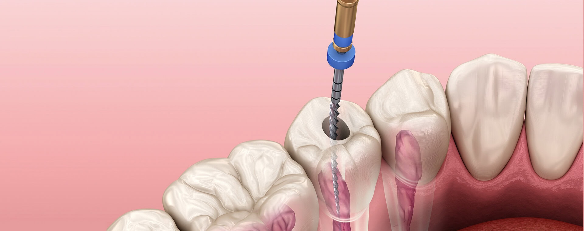 root canal