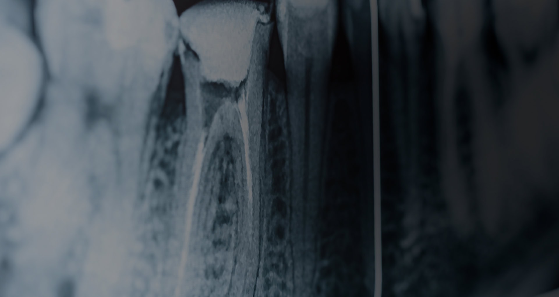 root canal2