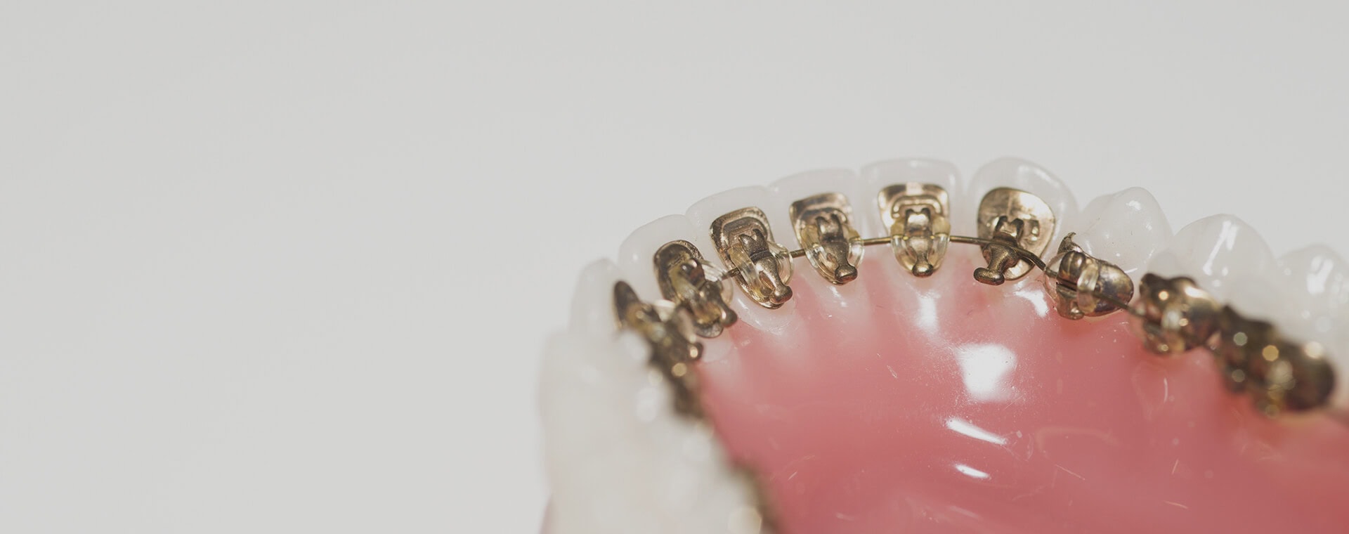 STb lingual braces at Ascent Dental Care in Solihull