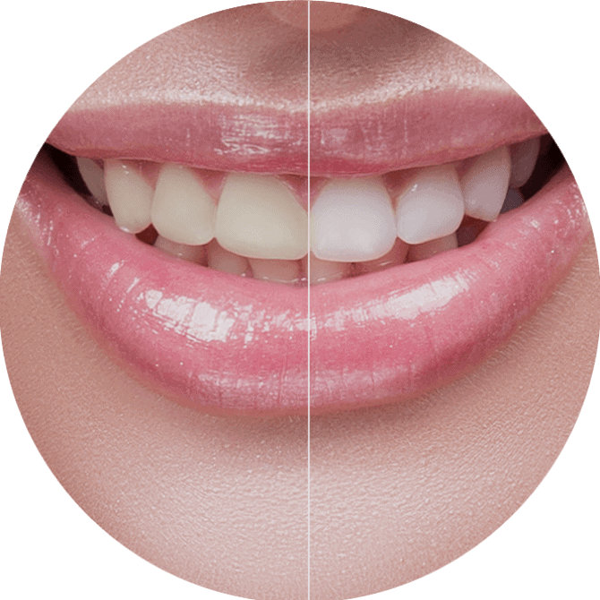 whiten