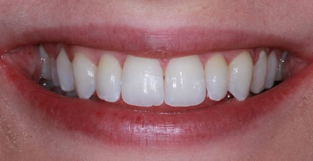 invisafter1@2x
