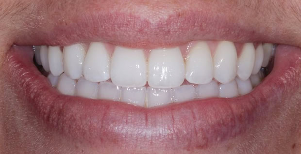 invisafter2@2x
