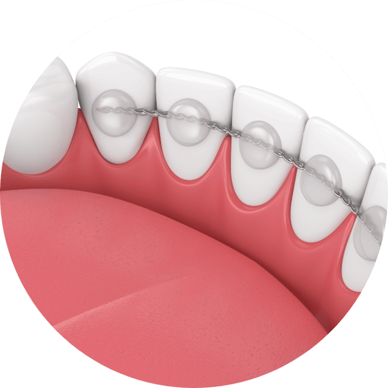 orthodontic bonded retainers at ascent dental care in solihull