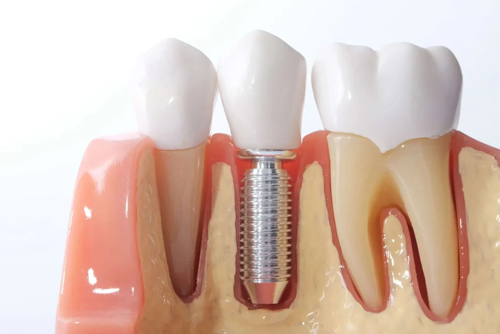 الغرسات البطانية Endosteal implants 