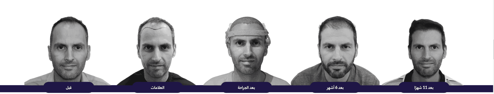 Hair Transplant Growth Stages Over One Year at Al Hokail: Pre-op, Grafting, Post-Op, 6 Months, 11 Months