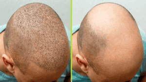 نتائج عملية زراعة الشعر