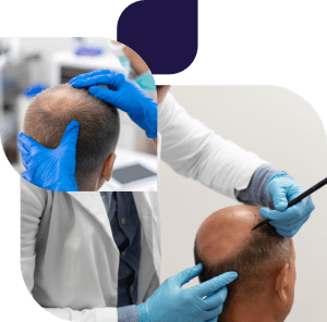 عملية زراعة الشعر