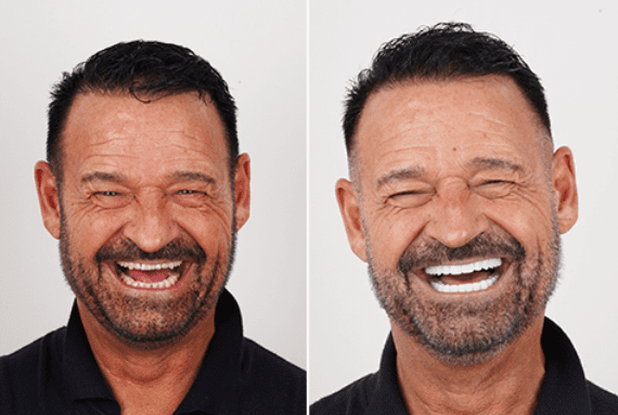 صور ابتسامة هوليود والنتائج قبل وبعد