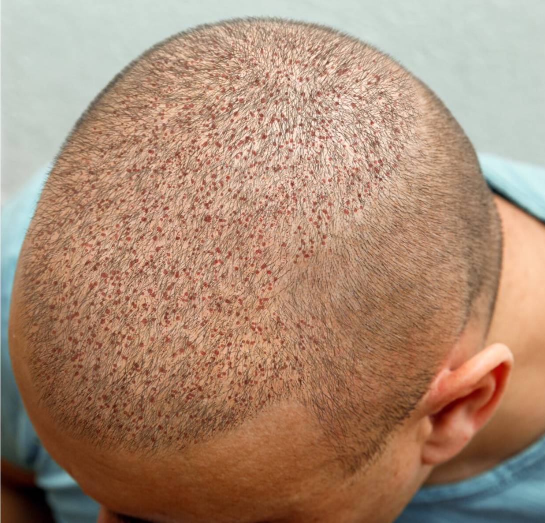 After Hair Transplant Surgery at Al Hokail Clinics