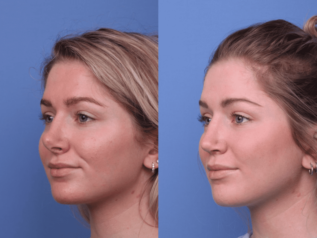 قبل وبعد عملية تجميل الأنف