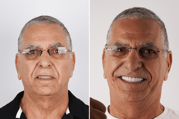 نتائج ابتسامة هوليود قبل وبعد