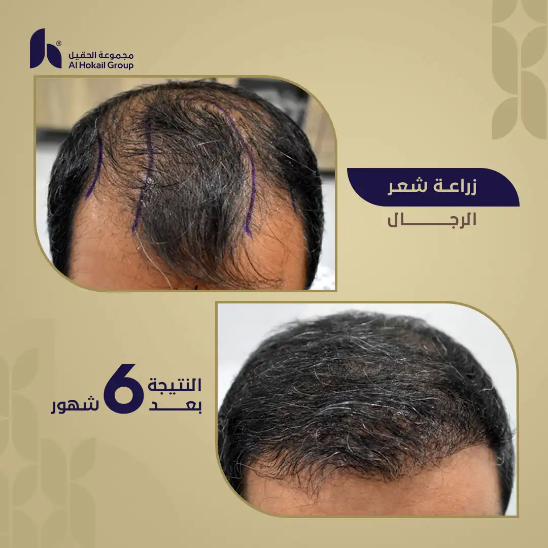 حالة 8 زراعة الشعر