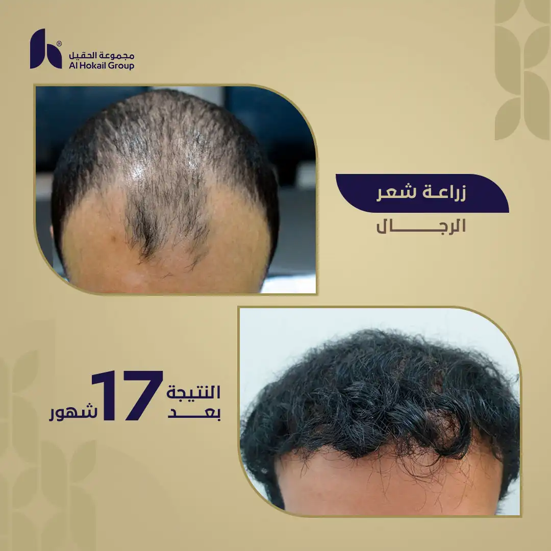حالة 7 زراعة الشعر