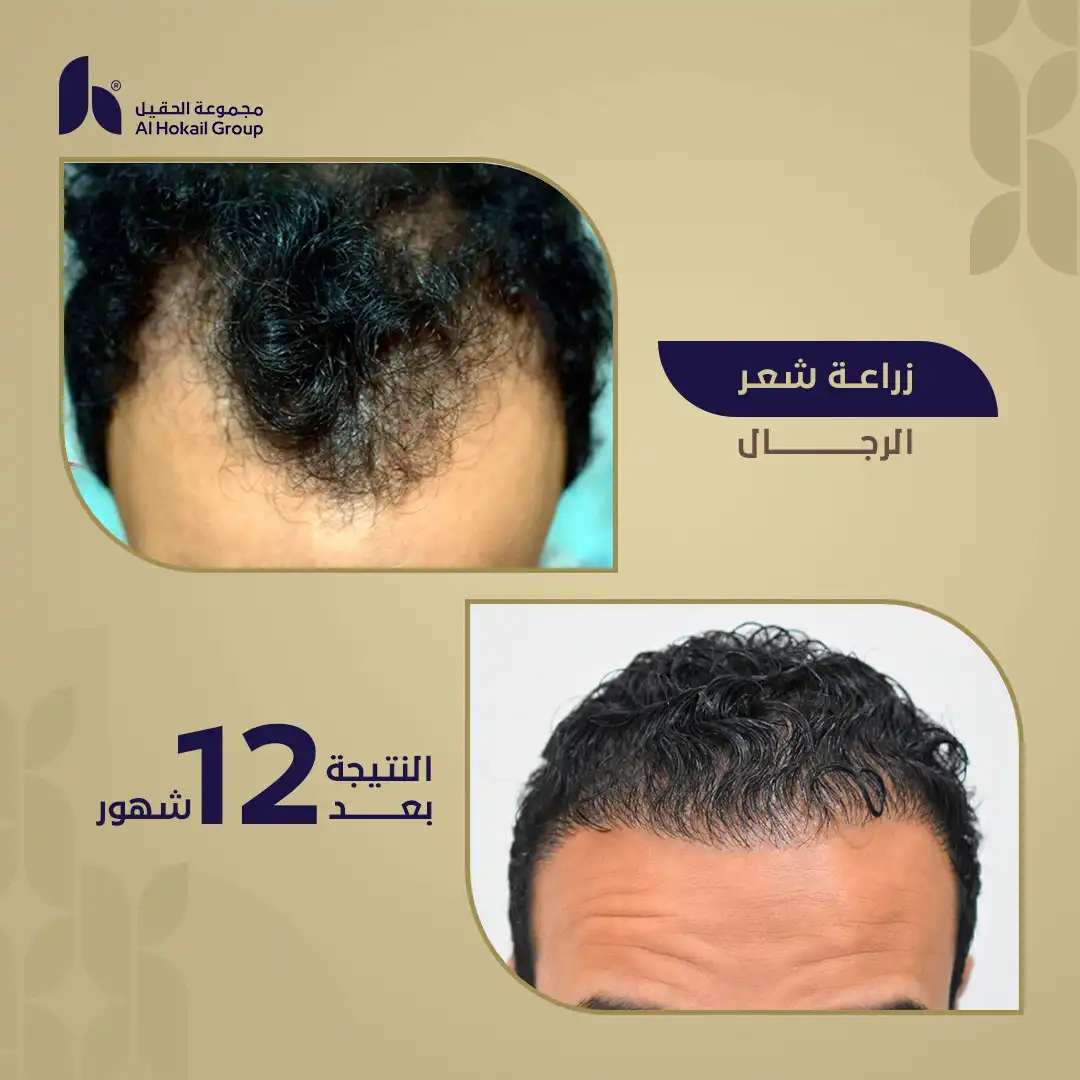 حالة 6 زراعة الشعر