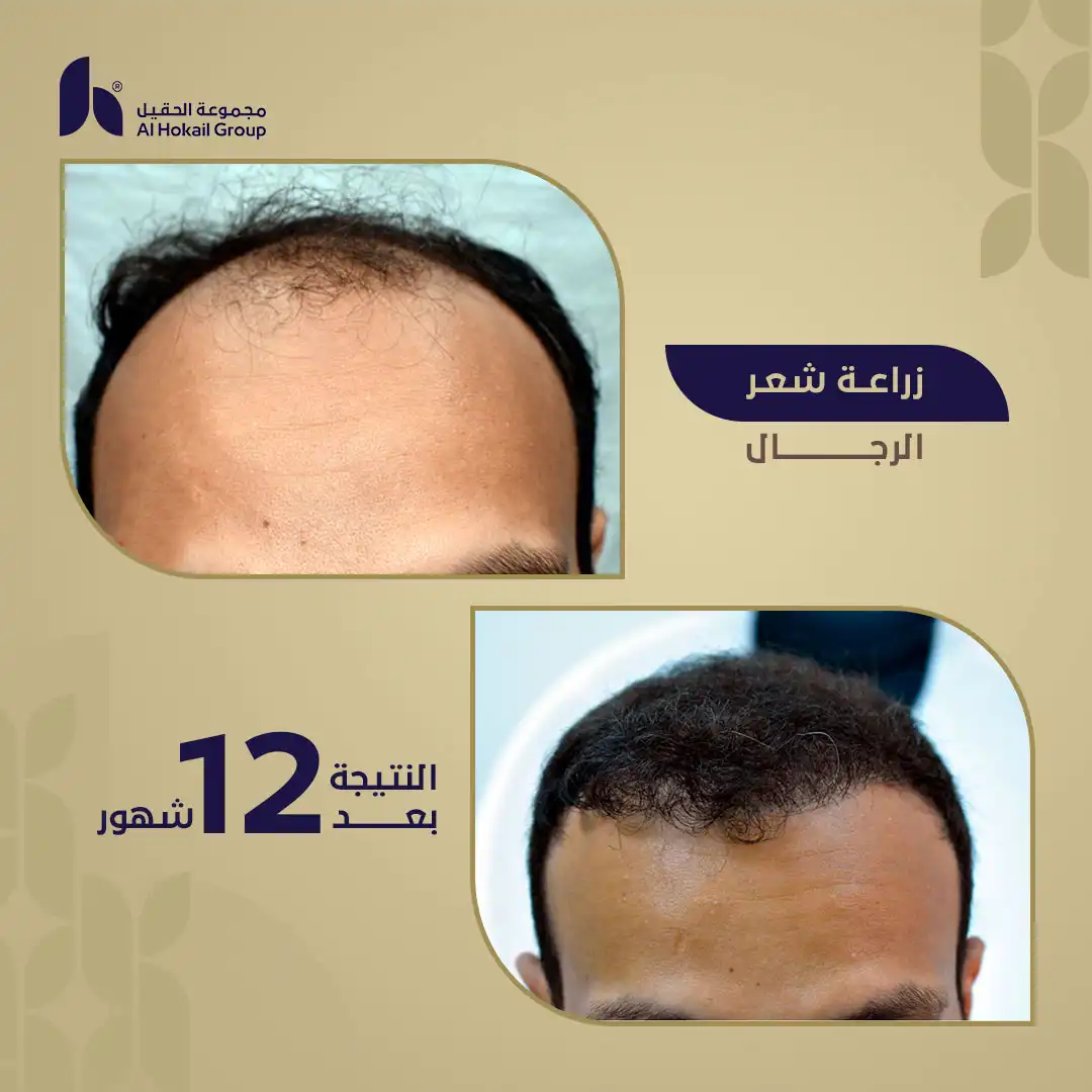 حالة 5 زراعة الشعر