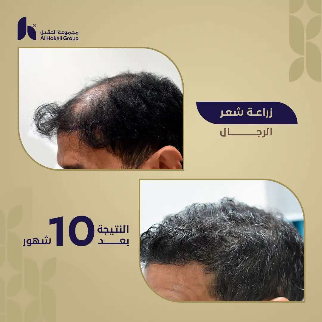 حالة 4 زراعة الشعر