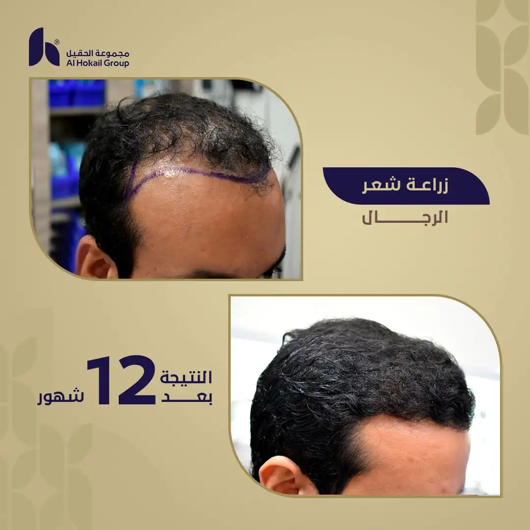 حالة 3 زراعة الشعر