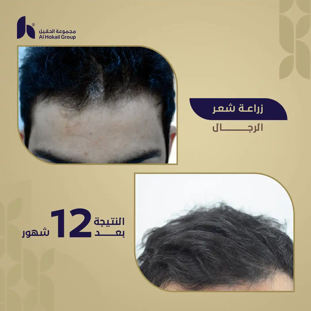 حالة 2 زراعة الشعر