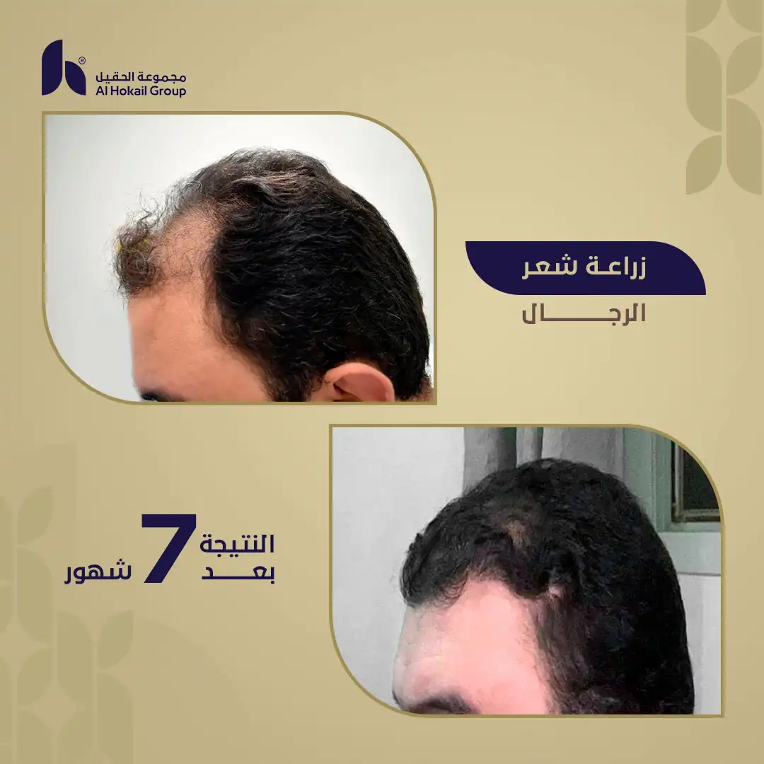حالة 1 زراعة الشعر