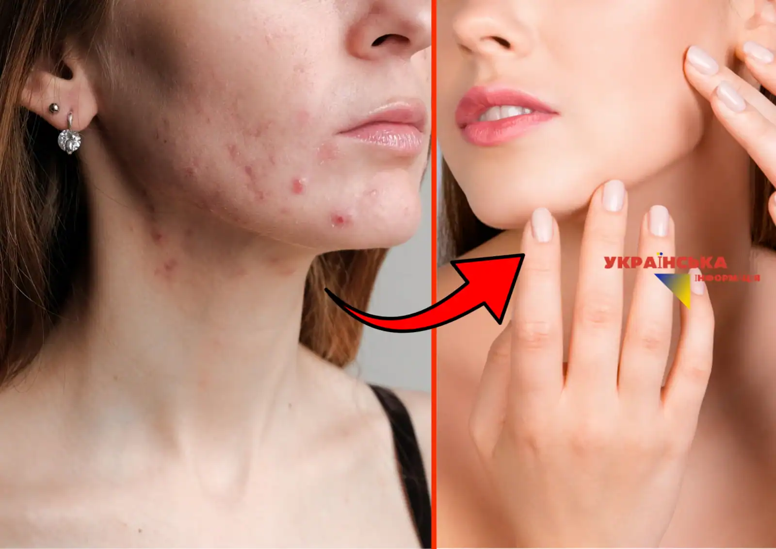Acne on the face: causes and what really helps against acne