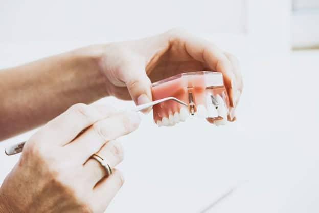 Hands holding a model of a human maxilla, pointing to dental implants