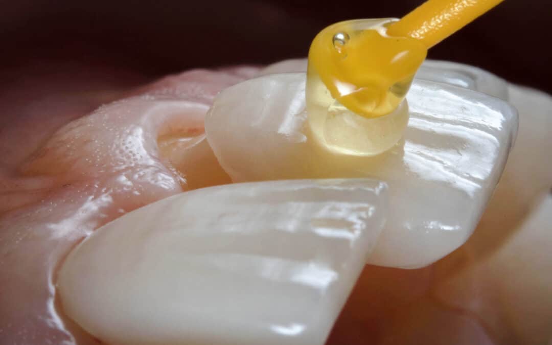 close up of porcelain veneers being placed