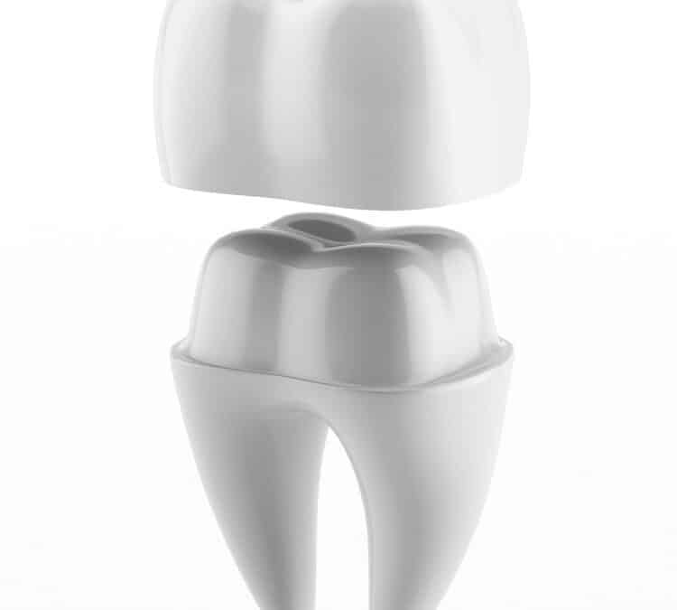 Dental Crowns After Root Canal Treatment: Why Are They Necessary?