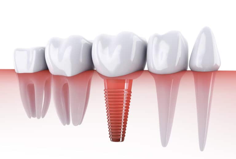 How Long Do Dental Implants Last? What You Should Know About Their Longevity