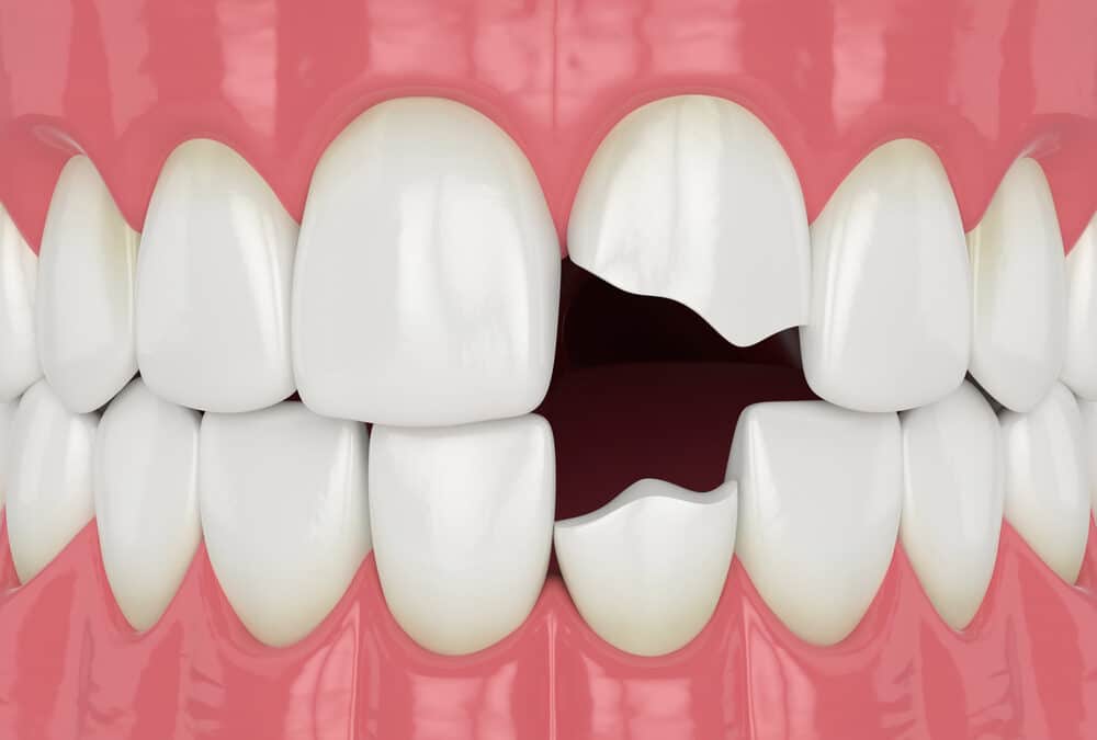 chipped front tooth on top and bottom