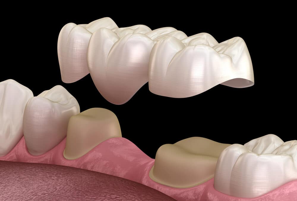 dental bridge hovering over shaved down teeth