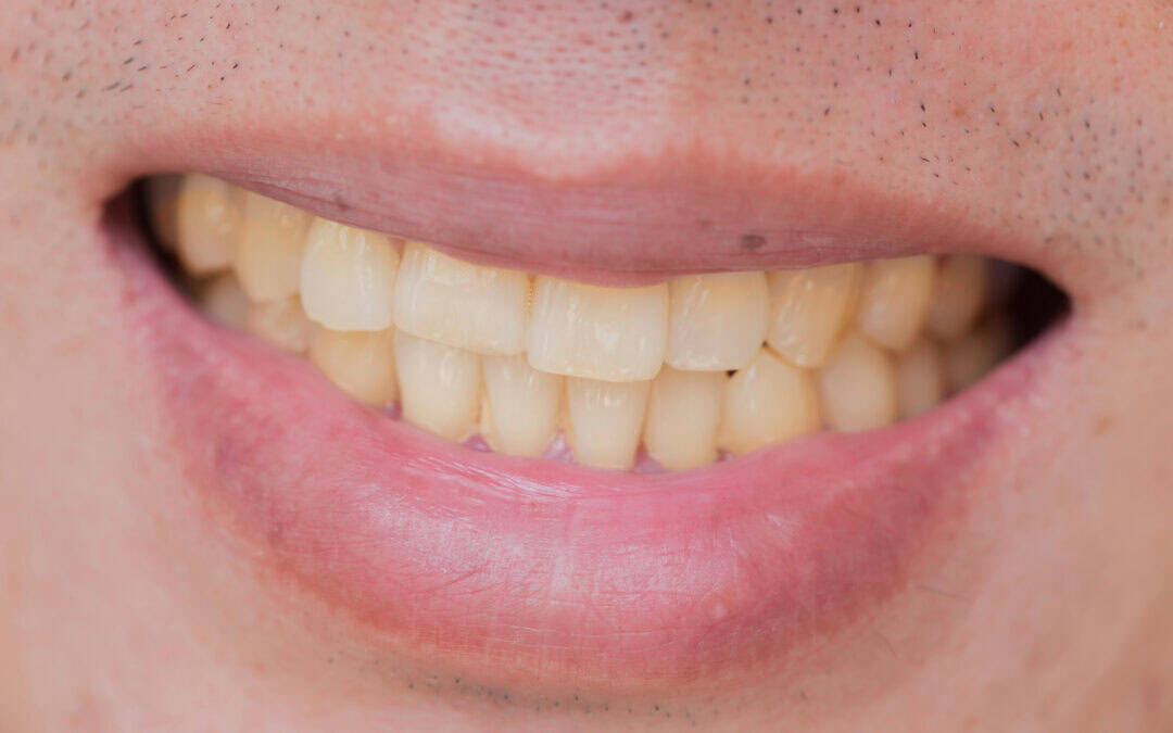 Can Allergy Medication Cause Discolored Teeth?