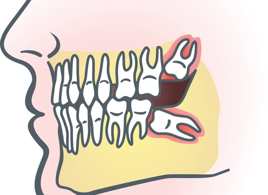 Can a Wisdom Tooth Shift Your Other Teeth?