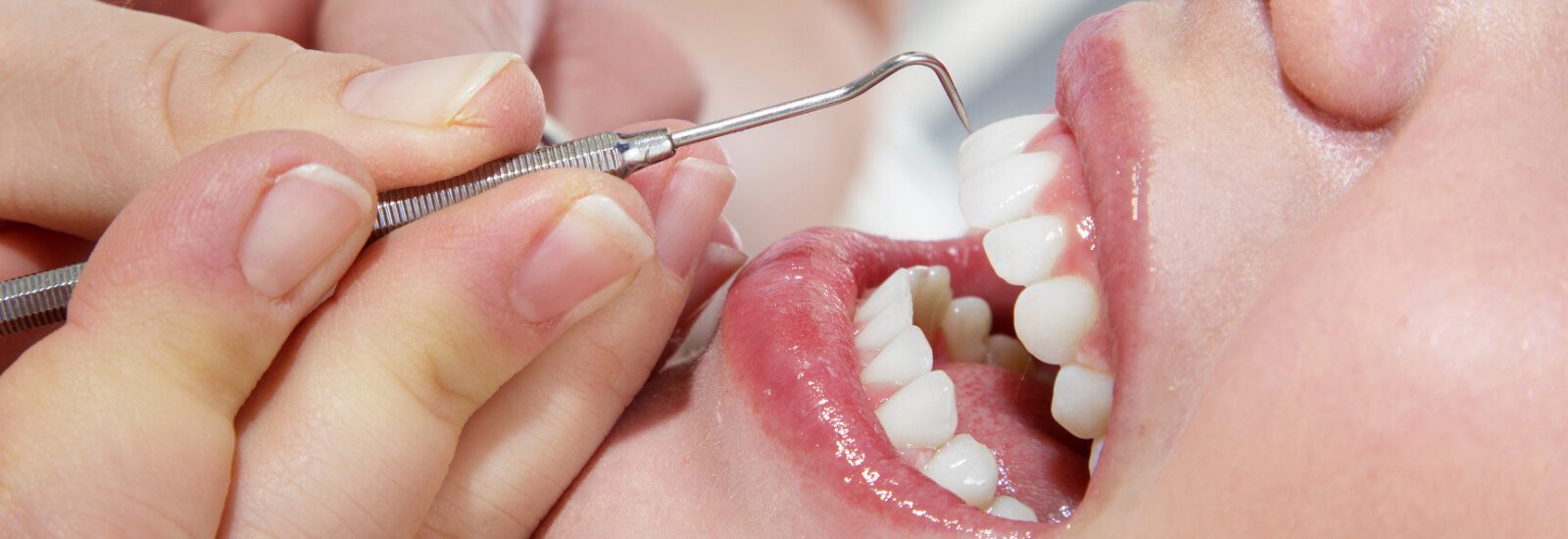 https://spcdn.shortpixel.ai/spio/ret_img+q_cdnize+to_webp+s_webp/www.alanyadentalservice.com/wp-content/uploads/dental-cleaning.jpeg