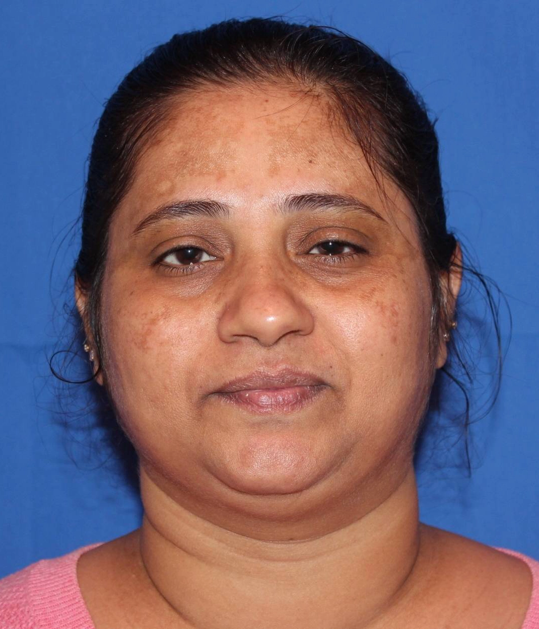 Before - Chemical Peel / Melasma Patient 89