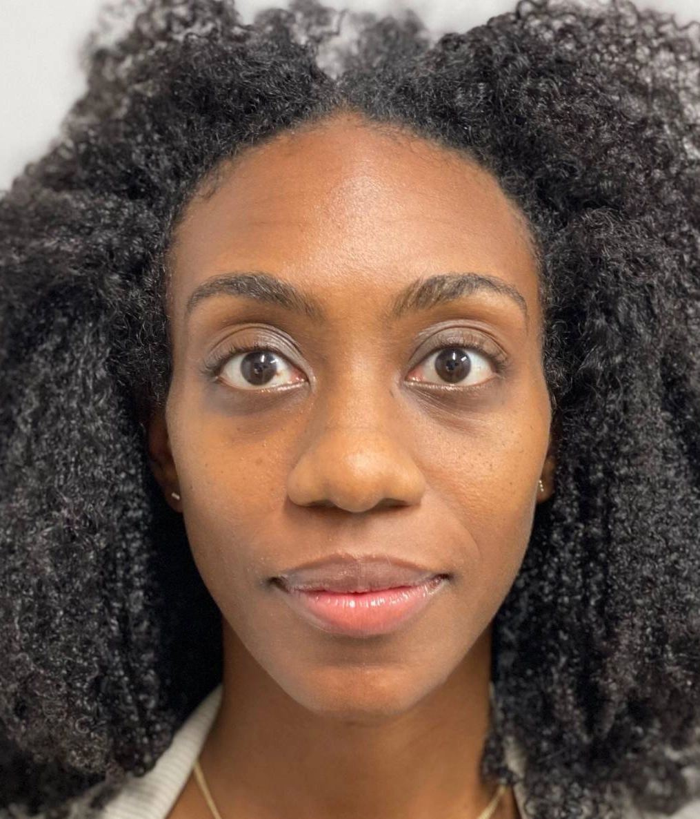 After - Facial Balancing / Fillers Patient 103