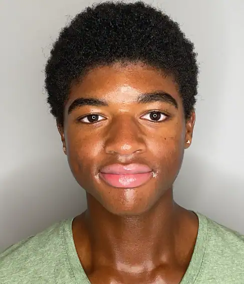 After - Acne Treatment Patient 132