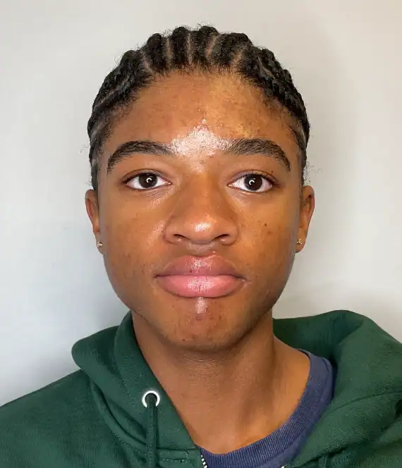 Before - Acne Treatment Patient 132