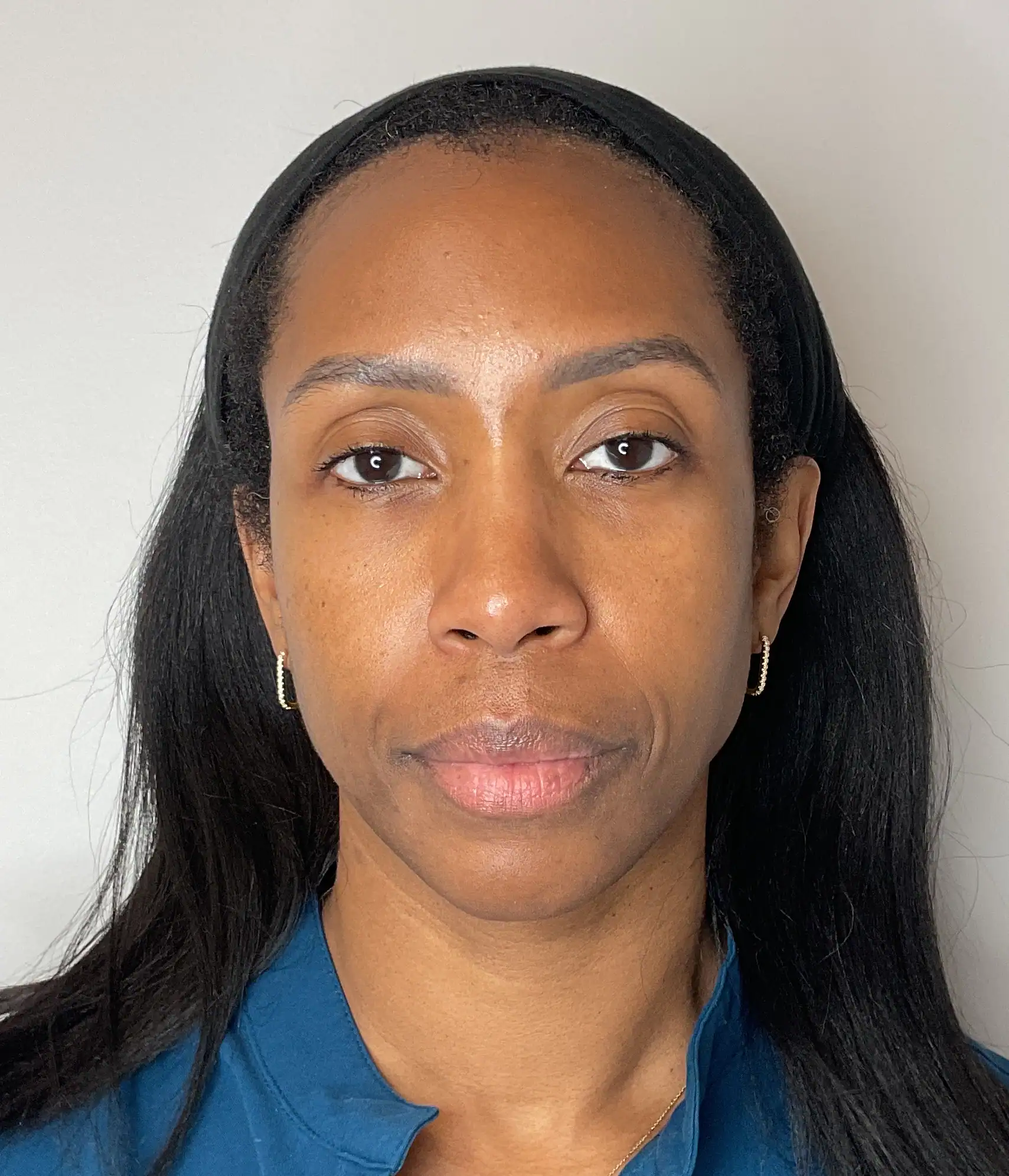 After - Facial Balancing / Filler Treatment Patient 133