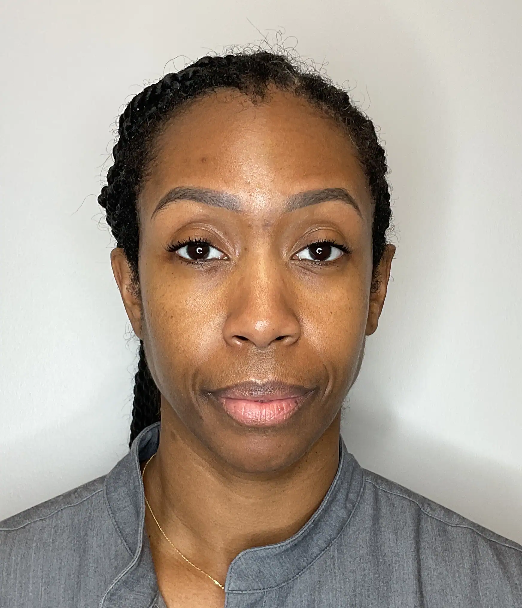 Before - Facial Balancing / Filler Treatment Patient 133