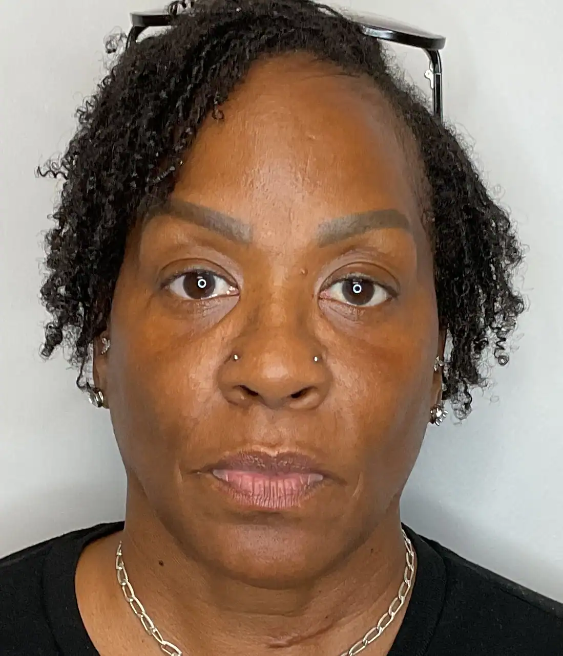 After - Facial Balancing / Filler Treatment Patient 135
