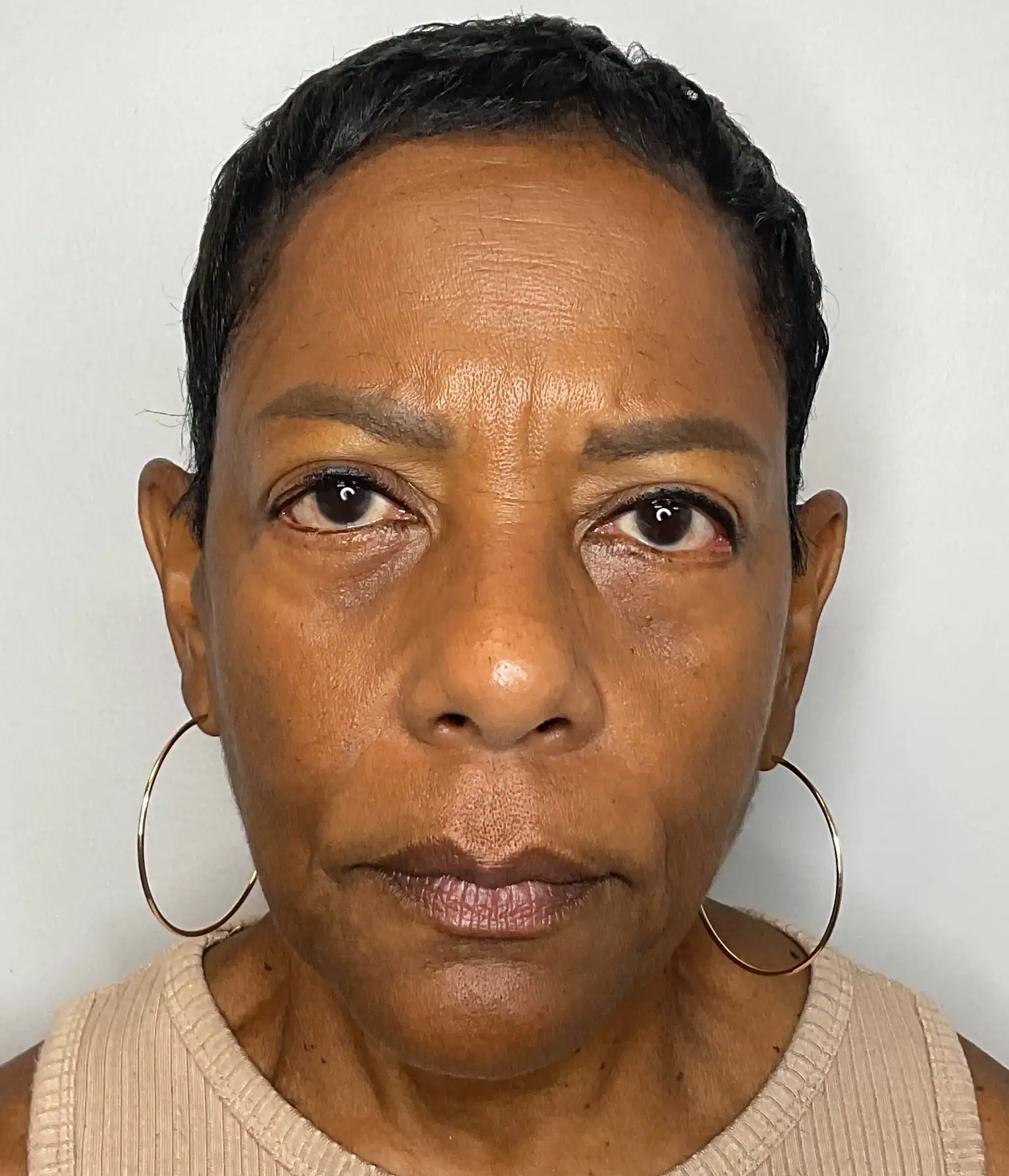Before - Facial Balancing / Filler Treatment Patient 136