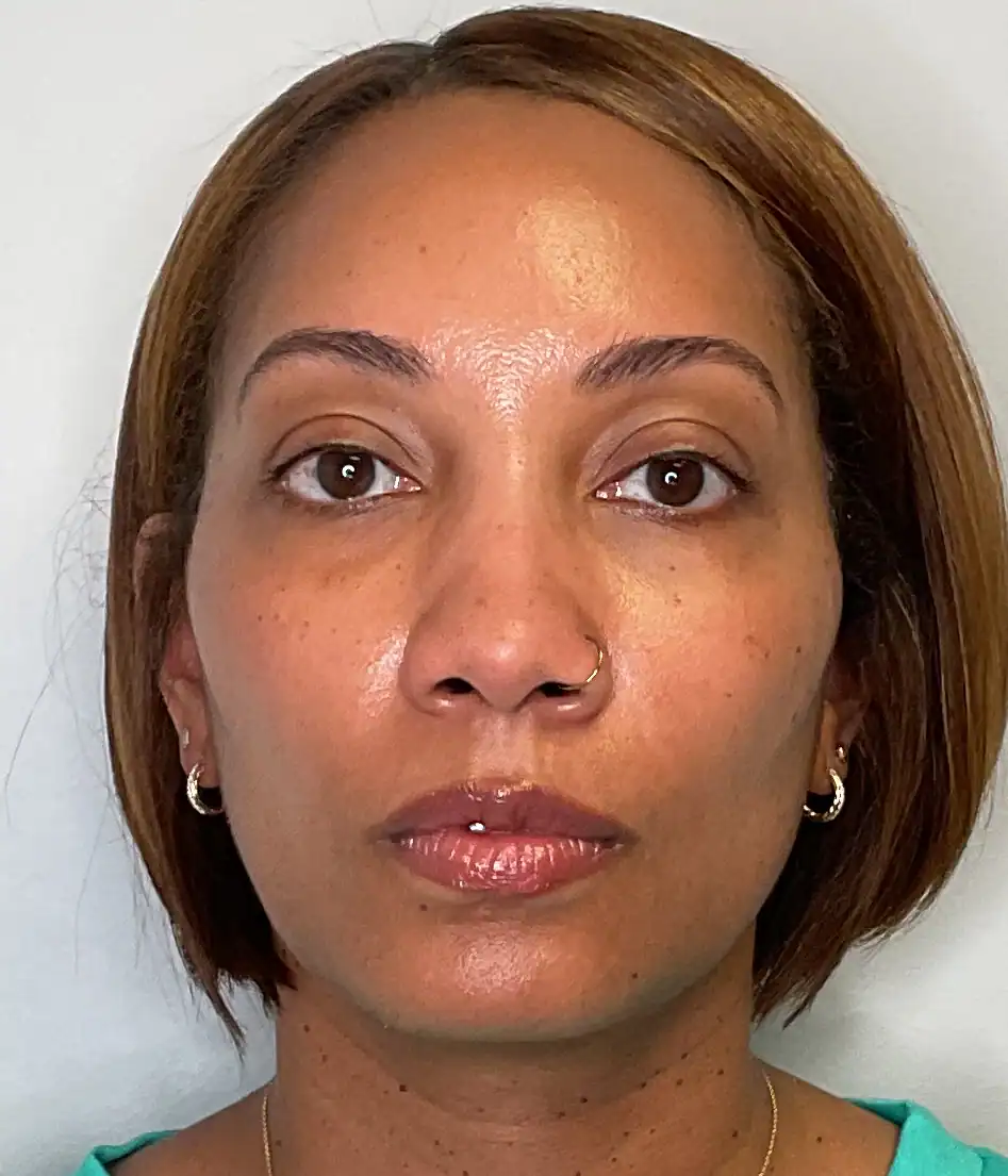 After - Facial Balancing / Filler Treatment Patient 137